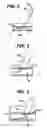 Fig. 03 - Vessel wound closure device