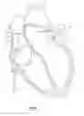 Fig. 02 - Method for accessing the left atrial appendage with a balloon-tipped transeptal sheath