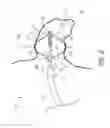 Fig. 03 - Method for accessing the left atrial appendage with a balloon-tipped transeptal sheath