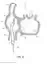 Fig. 08 - Method for accessing the left atrial appendage with a balloon-tipped transeptal sheath