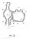 Fig. 10 - Method for accessing the left atrial appendage with a balloon-tipped transeptal sheath
