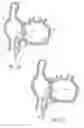 Fig. 11 - Method for accessing the left atrial appendage with a balloon-tipped transeptal sheath