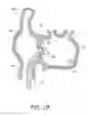 Fig. 13 - Method for accessing the left atrial appendage with a balloon-tipped transeptal sheath