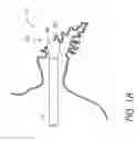 Fig. 15 - Method for accessing the left atrial appendage with a balloon-tipped transeptal sheath