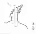 Fig. 16 - Method for accessing the left atrial appendage with a balloon-tipped transeptal sheath