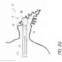 Fig. 17 - Method for accessing the left atrial appendage with a balloon-tipped transeptal sheath