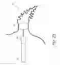 Fig. 20 - Method for accessing the left atrial appendage with a balloon-tipped transeptal sheath