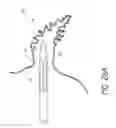 Fig. 26 - Method for accessing the left atrial appendage with a balloon-tipped transeptal sheath