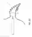 Fig. 28 - Method for accessing the left atrial appendage with a balloon-tipped transeptal sheath
