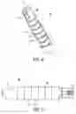 Fig. 03 - Suture anchor with insert-molded suture eyelet