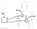 Fig. 01 - Defibrillation electrode having drug delivery capablity