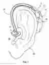 Fig. 02 - Non-invasive device and method for electrical stimulation of neural tissue