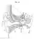 Fig. 02 - Conformal electrode pad for a stimulating medical device