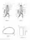 Fig. 04 - Methods and systems for aneurysm treatment using filling structures