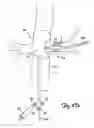 Fig. 10 - Embolic protection systems for bifurcated conduits