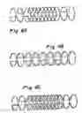 Fig. 05 - Methods And Apparatus For Treating Aneurysms And Other Vascular Defects