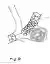 Fig. 09 - Methods And Apparatus For Treating Aneurysms And Other Vascular Defects