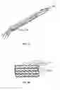 Fig. 03 - Methods and devices for intervertebral augmentation