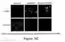 Fig. 08 - Use of eIF-5A to kill multiple myeloma cells