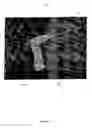 Fig. 02 - Device and method for rapid aspiration and collection of body tissue from within an enclosed body space