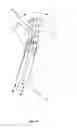 Fig. 05 - Device and method for rapid aspiration and collection of body tissue from within an enclosed body space