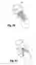 Fig. 07 - Implantable graft material
