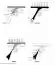Fig. 03 - Drug delivery method by enhanced topical application