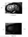 Fig. 02 - Augmentation of intraluminal microvessel formation to facilitate guide wire crossing in chronic total occlusions