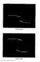 Fig. 06 - Augmentation of intraluminal microvessel formation to facilitate guide wire crossing in chronic total occlusions