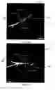 Fig. 07 - Augmentation of intraluminal microvessel formation to facilitate guide wire crossing in chronic total occlusions