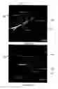 Fig. 08 - Augmentation of intraluminal microvessel formation to facilitate guide wire crossing in chronic total occlusions