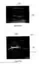 Fig. 09 - Augmentation of intraluminal microvessel formation to facilitate guide wire crossing in chronic total occlusions
