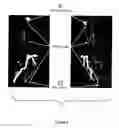 Fig. 11 - Augmentation of intraluminal microvessel formation to facilitate guide wire crossing in chronic total occlusions