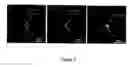 Fig. 12 - Augmentation of intraluminal microvessel formation to facilitate guide wire crossing in chronic total occlusions