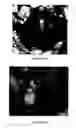 Fig. 14 - Augmentation of intraluminal microvessel formation to facilitate guide wire crossing in chronic total occlusions