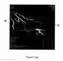 Fig. 15 - Augmentation of intraluminal microvessel formation to facilitate guide wire crossing in chronic total occlusions