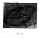 Fig. 17 - Augmentation of intraluminal microvessel formation to facilitate guide wire crossing in chronic total occlusions