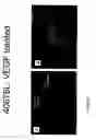 Fig. 26 - Augmentation of intraluminal microvessel formation to facilitate guide wire crossing in chronic total occlusions