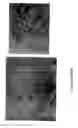 Fig. 30 - Augmentation of intraluminal microvessel formation to facilitate guide wire crossing in chronic total occlusions