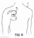 Fig. 08 - Implantable cell/tissue-based biosensing device