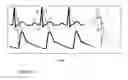 Fig. 02 - Methods and apparatus for selecting intra-aortic balloon deflation timing