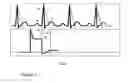 Fig. 03 - Methods and apparatus for selecting intra-aortic balloon deflation timing