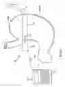 Fig. 02 - Self-regulating gastric band with pressure data processing