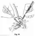 Fig. 25 - Surgical retractor platform blade apparatus