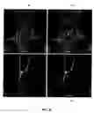 Fig. 07 - Medical device system and method for tracking and visualizing a medical device system under MR guidance