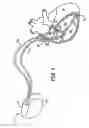 Fig. 02 - Cardiac therapy system including a triboelectric sensor