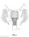 Fig. 07 - Cervimeter