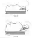 Fig. 06 - Glaucoma Treatment Devices and Methods