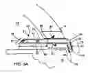 Fig. 10 - Glaucoma Treatment Devices and Methods