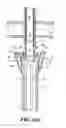 Fig. 06 - Catheter assembly and method for internally anchoring a catheter in a patient